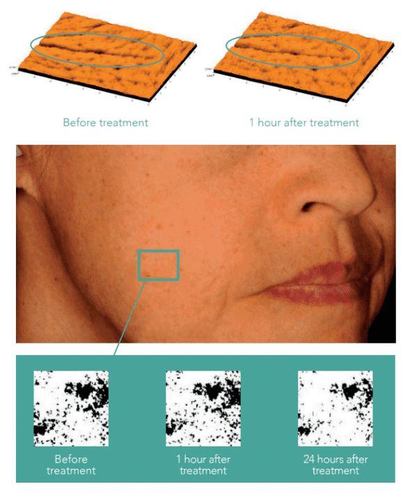Lumination Peeling Facial Clinically Proven Results